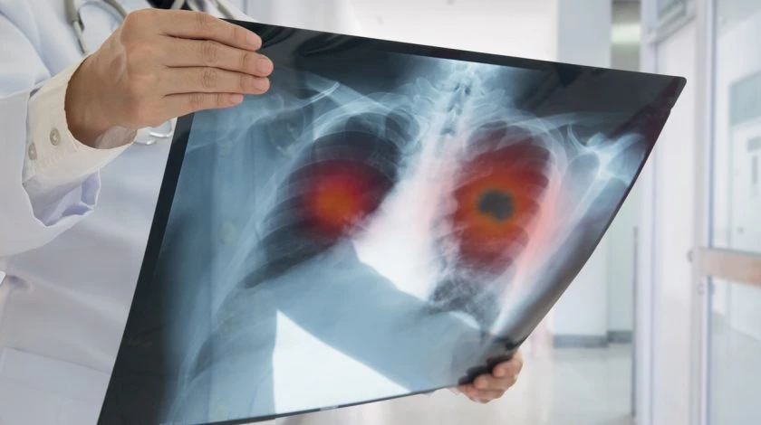 lung-cancer-image-840x470