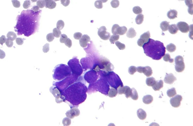 1024px-Small_cell_lung_cancer_-_cytology-1-e1666001268783