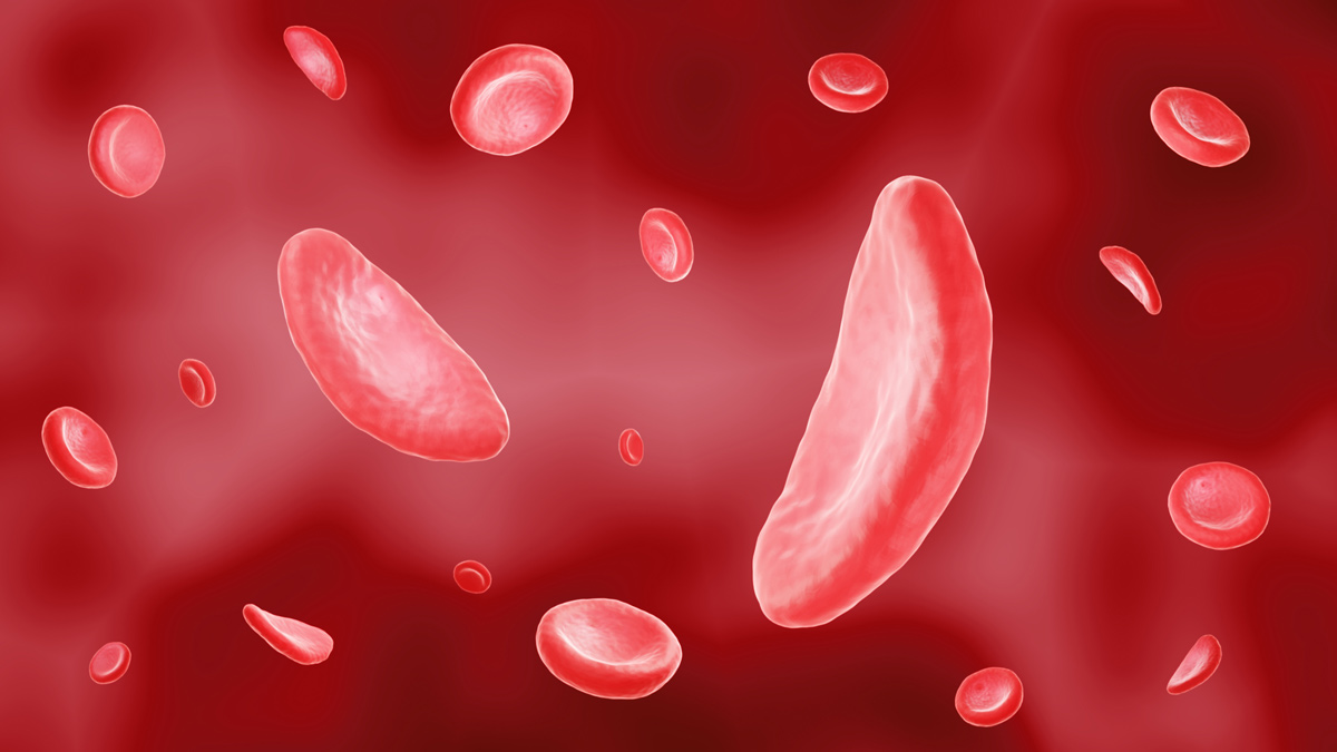 sickle-cell